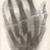 指のケガ予防には、手の甲の拮抗筋を鍛えよう