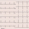 ECG-201：90才代女性。布団を敷いていて、失神しました。