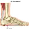 What Is Plantar Fasciitis