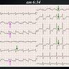 ECG-124：answer