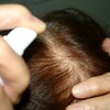 育毛剤のみで髪は生えるか？