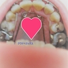 歯科矯正26上顎拡大装置が終了しました