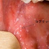 麻疹（ましん、はしか）に注意！！！とっても怖い麻疹！！！重篤な後遺症や死ぬこともあります。