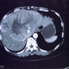 【追記】 肝臓のMRI
