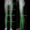 Exercises To Improve Leg Length Discrepancy