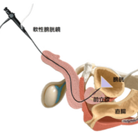 膀胱鏡検査
