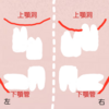 親知らず、抜きましたか？