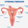 PELVIC CRAMPING AND HEAVY BLEEDING: UTERINE FIBROID MIGHT BE REASON