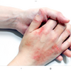 子供の手の湿疹、消毒しすぎ？