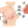 乳癌手術終わりました