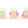 歯周病があるとインフルエンザが重症化する？