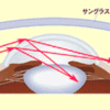 白内障術後眼内レンズ挿入眼患者さんの耳側視野異常　by B