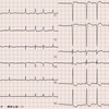 【ECG-187】90才代女性。移行帯部分のお話しです。