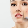 Joyelle Derma Skin Cream Reviews Buy, Price, Side Effects, Benefits