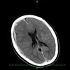 急性硬膜下血腫 acute subdural hematoma