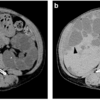 case146：特発性細菌性腹膜炎との鑑別を要する疾患（BMC Gastroenterol. 2021 Jun 24;21(1):267.）