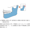 オープンバイトとＴＭＤ（顎関節症）ー　ノルウェー事情 その２