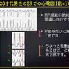 【ECG-215】answer