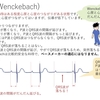 不整脈：房室ブロック(AVB)について　その2：Ⅰ、Ⅱ度房室ブロックと高度房室ブロック　〜基本32〜