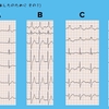 【コラム-143】CRBBBの本質-あしたのために その1　#心電図検定試験2023