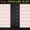 ECG-373：answer=心電図検定試験 傾向と対策 Q.19 =