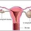 Mắc u nang buồng trứng có thai được hay không?