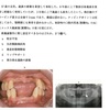 113回　義歯振り返り　新義歯製作編