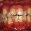 安易な歯列拡大・部分矯正・歯を削る方法