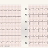 コラム-081：急性心外膜炎の心電図所見を考えます。