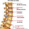 Nguyên do dẫn đến thoái hóa cột sống?