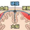 急性硬膜下血腫と硬膜外血腫の違い