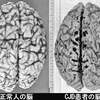 ワクチン）ワクチン接種者からプリオン蛋白が感染する説。