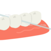 歯と歯の間の汚れ