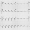 case 150：低酸素血症、低血圧を呈する80歳男性（J Emerg Med. 2017 May;52(5):741-743.）