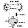 夏に増える尿路結石