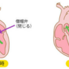 手術はなくなる？心臓弁の交換や動脈硬化はカテーテルで治療