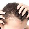 How to Stop Hair loss