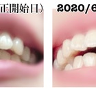 クソ出っ歯が 自称可愛い出っ歯 予定 になるまでの道のり 第1章 青く 正しく 美しく クソ出っ歯が 自称可愛い出っ歯 予定 になるまでの道のり 第1章 青く 正しく 美しく