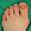 How To Heal Bunions