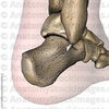 What Is The Most Effective Remedy For Posterior Calcaneal Spur