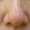 鼻の毛穴